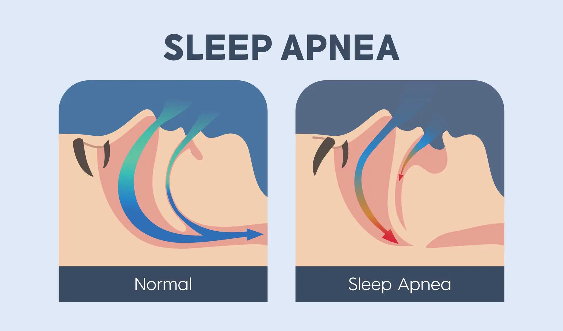 What Is Sleep Apnea?