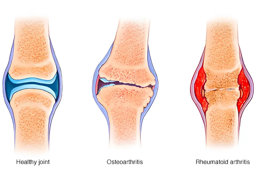 Diagram comparing a healthy joint, osteoarthritis, and rheumatoid arthritis in cross-section
